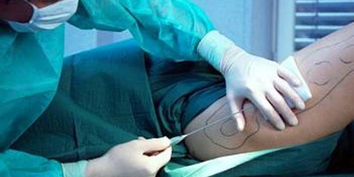 Como é Feita Uma Lipoaspiração