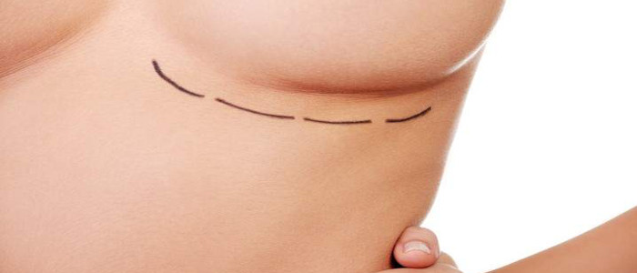 4 coisas para saber antes de colocar prótese de mama