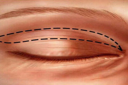 Como Funciona a Blefaroplastia?