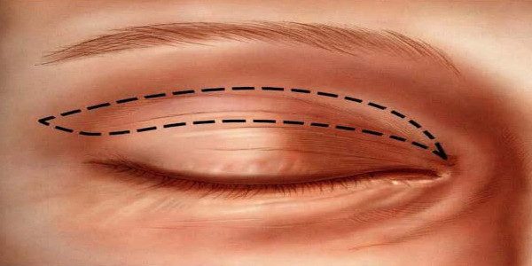 Como Funciona a Blefaroplastia?