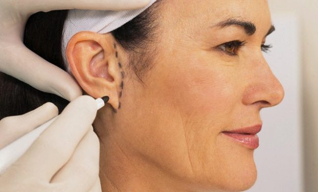 Como funciona a otoplastia?