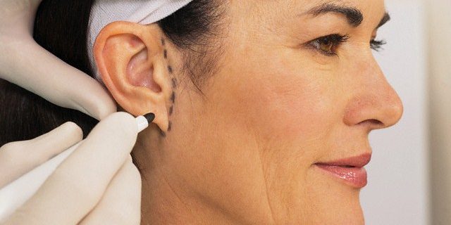 Como funciona a otoplastia?