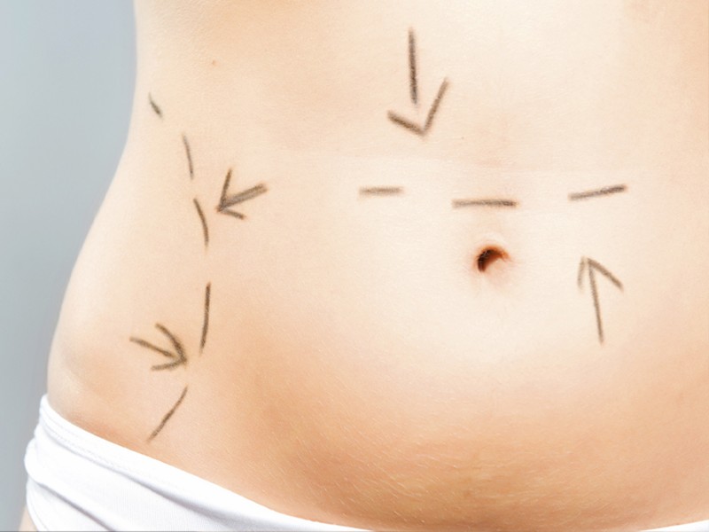 Planejamento de Abdominoplastia