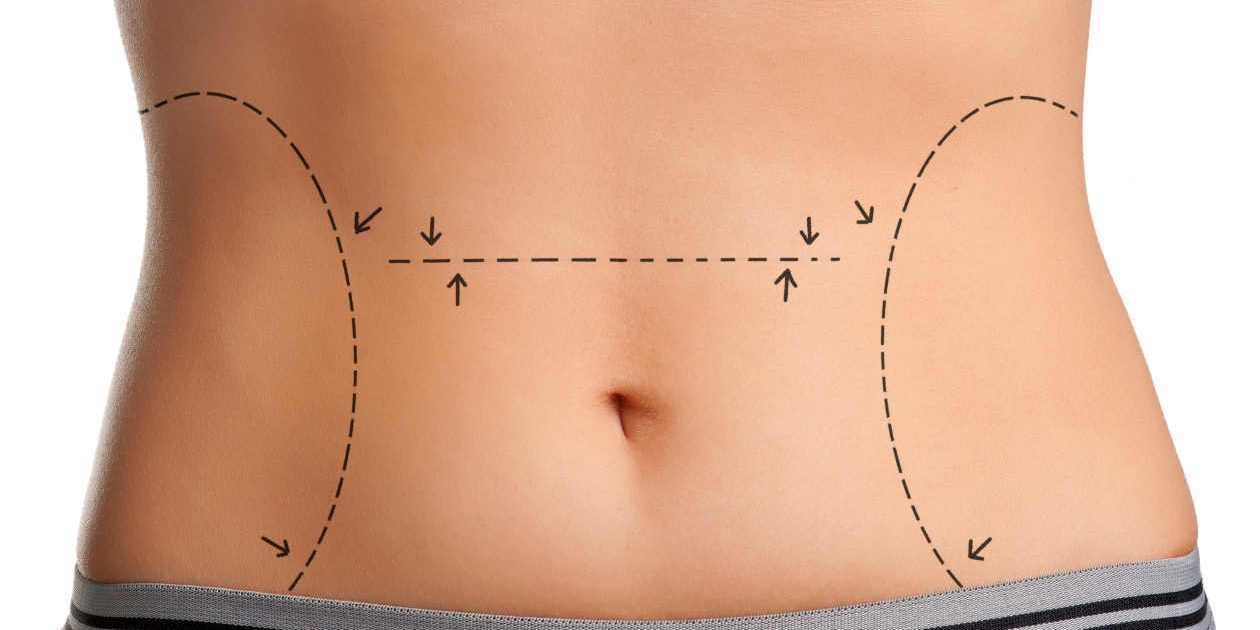 Recuperação da Abdominoplastia