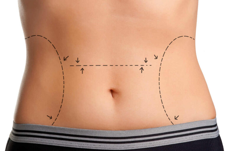Recuperação da Abdominoplastia