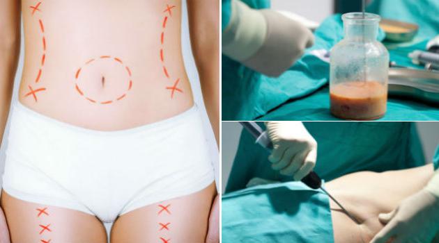 Lipoaspiracao e abdominoplastia