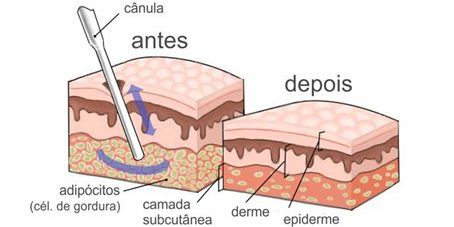como acabar com a gordura localizada