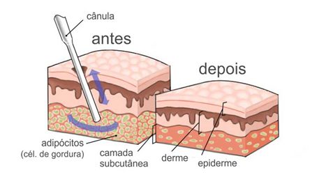 Lipoaspiração Tradicional