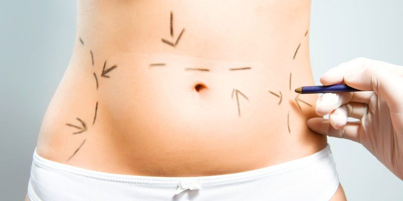 como pagar por uma cirurgia plástica