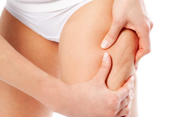 estrias e celulites na adolescência