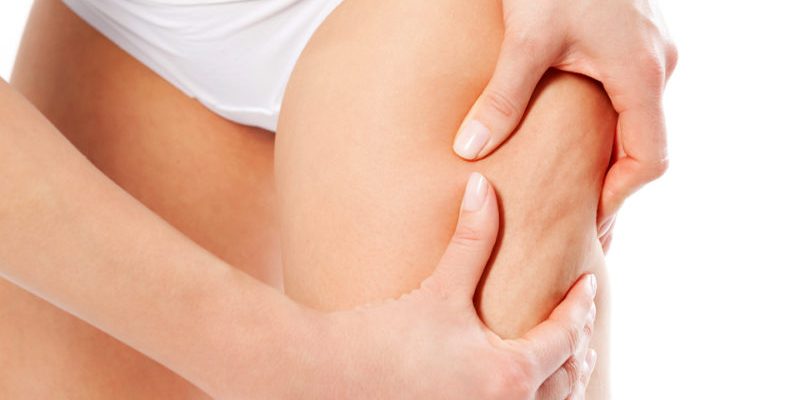 estrias e celulites na adolescência