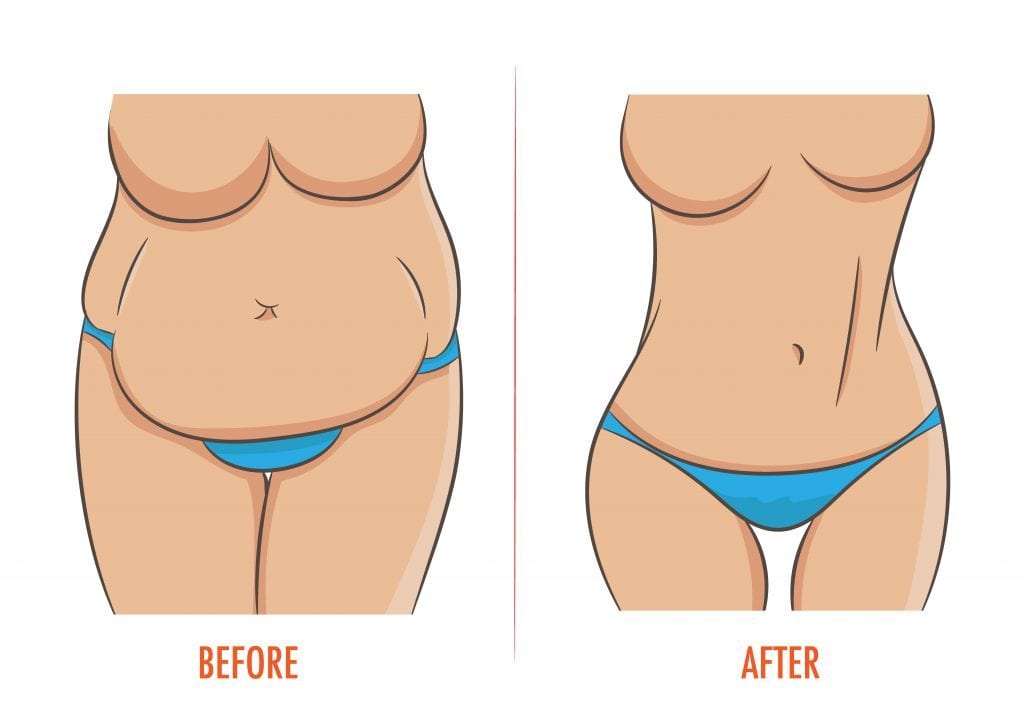 Mommy Makeover Abdomen Antes e Depois