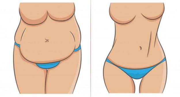 Mommy Makeover Abdomen Antes e Depois