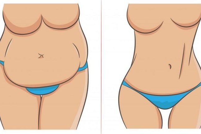 Mommy Makeover Abdomen Antes e Depois