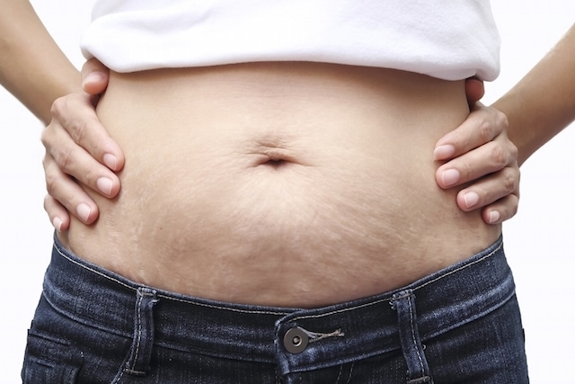 Flacidez: Principal indicação para a Abdominoplastia.