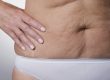 como eliminar a flacidez depois de emagrecer Cirurgia de Abdomen