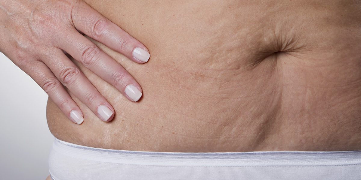 como eliminar a flacidez depois de emagrecer Cirurgia de Abdomen