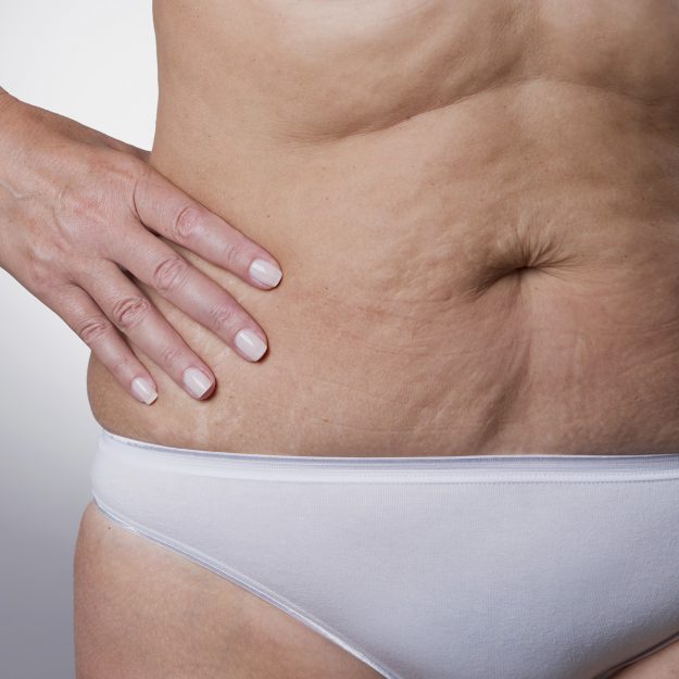 como eliminar a flacidez depois de emagrecer Cirurgia de Abdomen