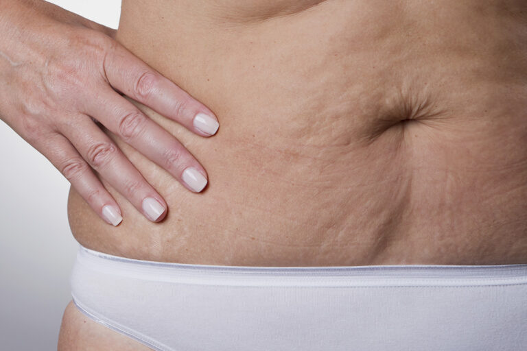 como eliminar a flacidez depois de emagrecer Cirurgia de Abdomen